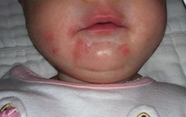 Rash Around Baby S Eyes And Mouth With Pic