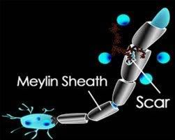 Multiple Sclerosis (MS)