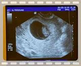 8w 1d ultrasound
